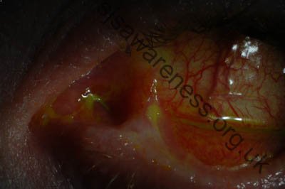 Left Eye - 24 year old male who suffered Toxic Epidermal Necrolysis Syndrome with severe Ocular involvement. Photo was taken 2 years after the initial TEN reaction (2)